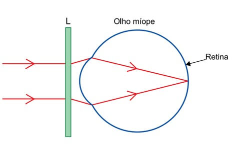 Para corrigir essa ametropia, ela utiliza óculos com lentes esféricas, como a representada por L na figura, que atuam em conjunto com as demais estruturas de seu globo ocular formando imagens nítidas na retina do olho.
