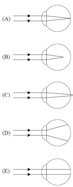 figura que representa a trajetória de raios de luz, provenientes de um pequeno objeto muito afastado, atingindo um de seus olhos, quando não está usando óculos.